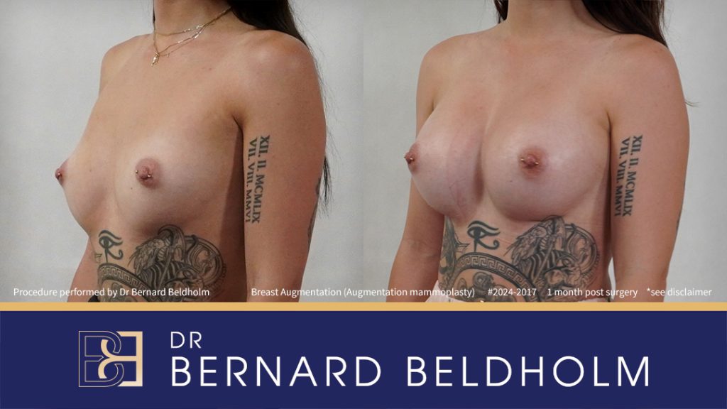 Patient 2024-2017 - Breast Augmentation (Augmentation Mammoplasty) - Right