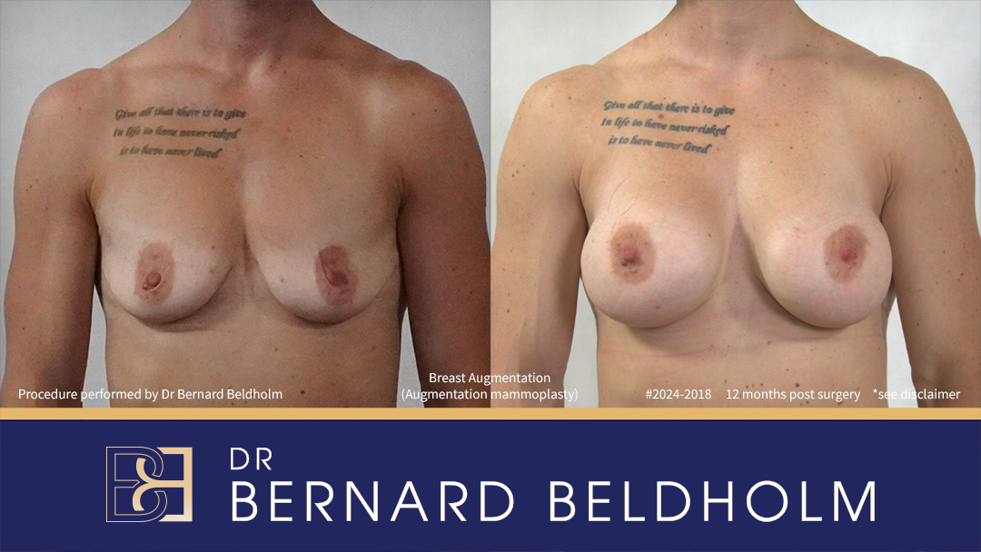 Patient 2024-2018 - Breast Augmentation (Augmentation Mammoplasty)