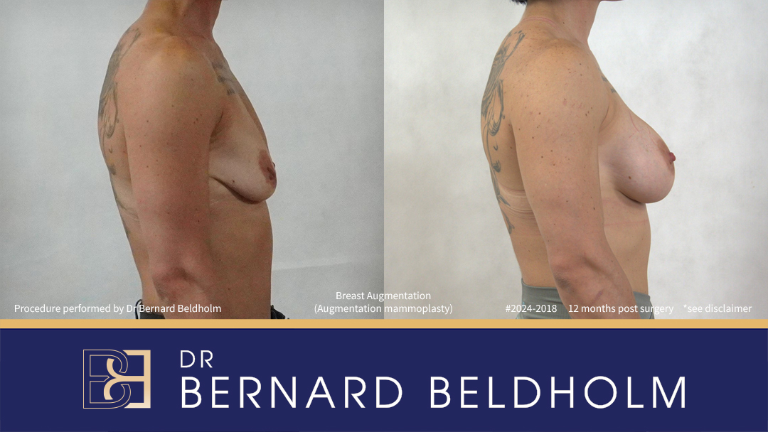 Patient 2024-2018 - Breast Augmentation (Augmentation Mammoplasty) - Left Side