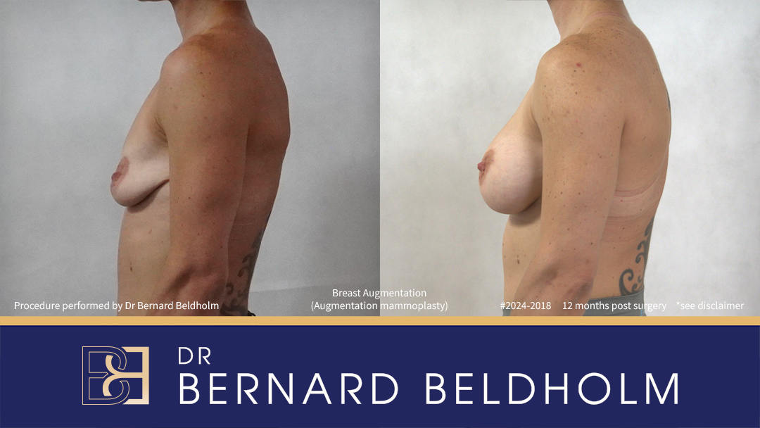 Patient 2024-2018 - Breast Augmentation (Augmentation Mammoplasty) - Right Side