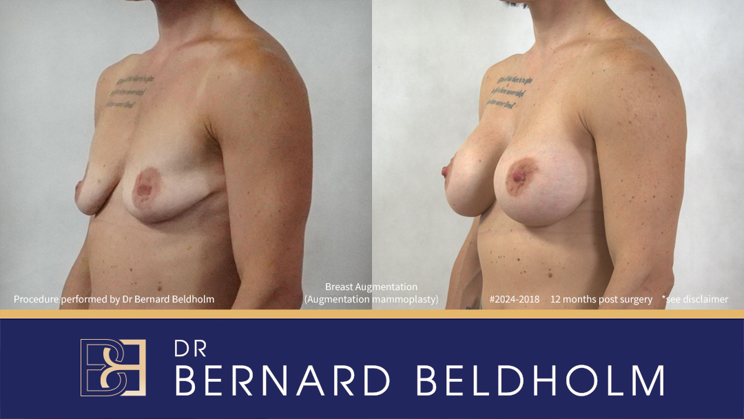 DrBB Website Horizontal Patient 2024 2018 Breast Augmentation 5