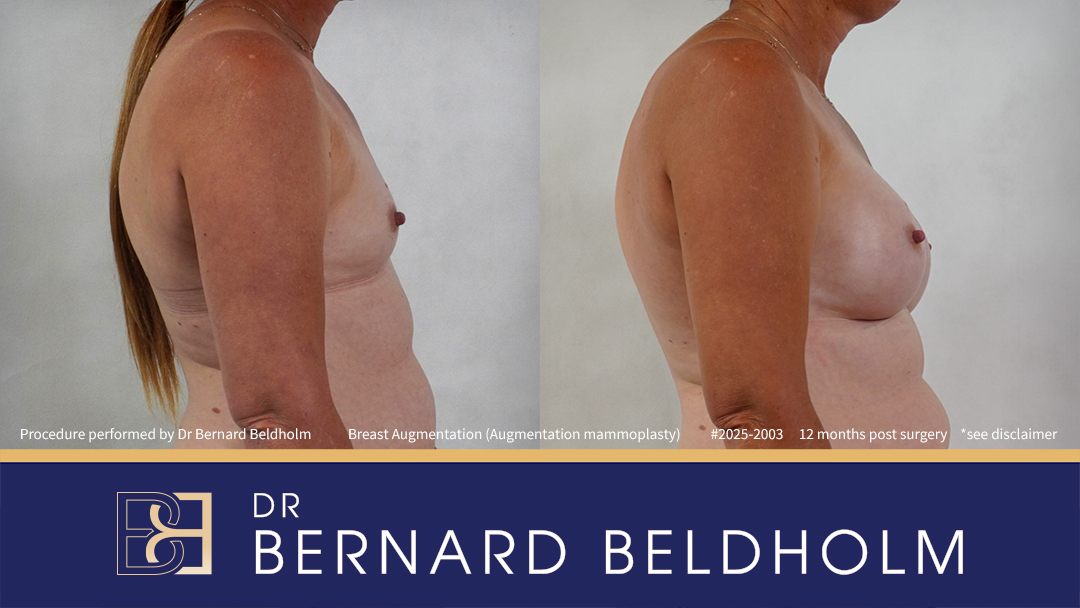 Round Breast Implants (Augmentation Mammoplasty) Patient 2025-2003 - Left Side