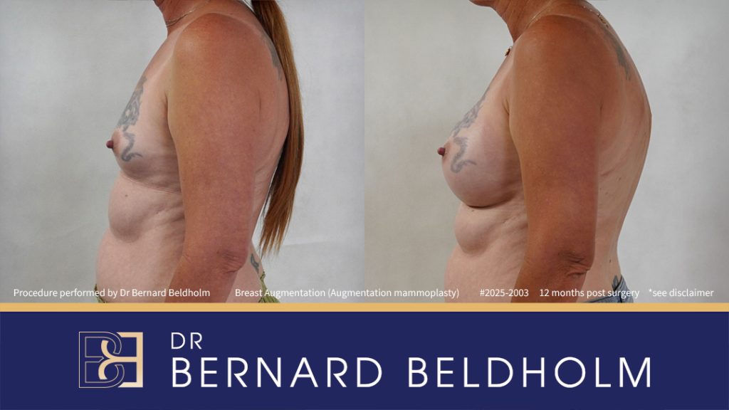 Round Breast Implants (Augmentation Mammoplasty) Patient 2025-2003 - Right Side