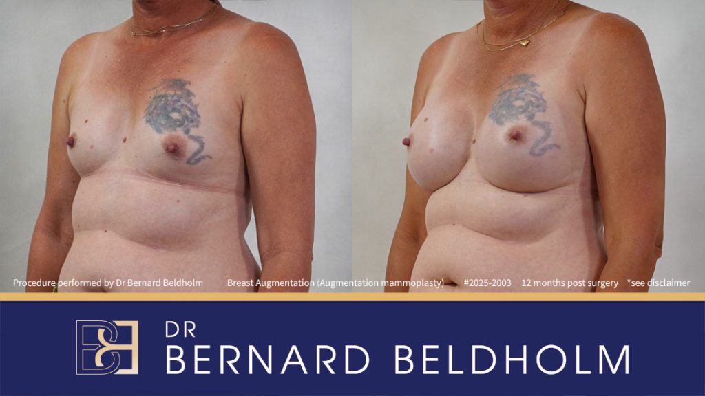 Round Breast Implants (Augmentation Mammoplasty) Patient 2025-2003 - Right