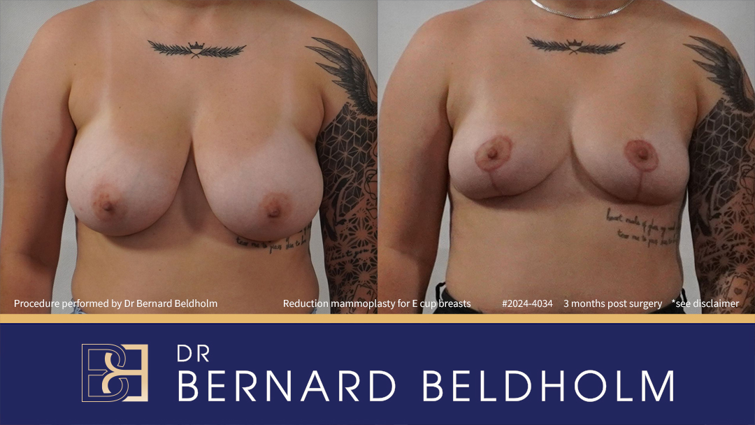 Patient 2023-4034 - Breast Reduction (Reduction Mammoplasty) for E Cup Breasts