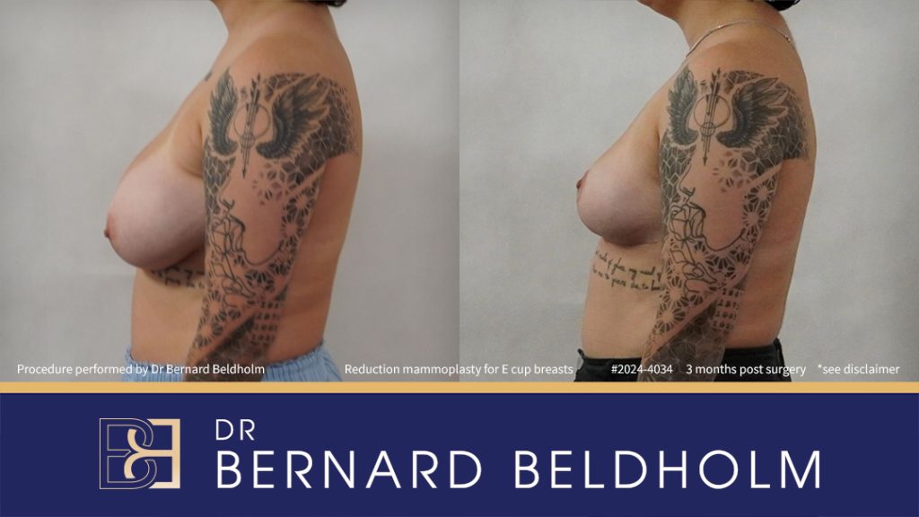Patient 2023-4034 - Breast Reduction (Reduction Mammoplasty) for E Cup Breasts - Right Side