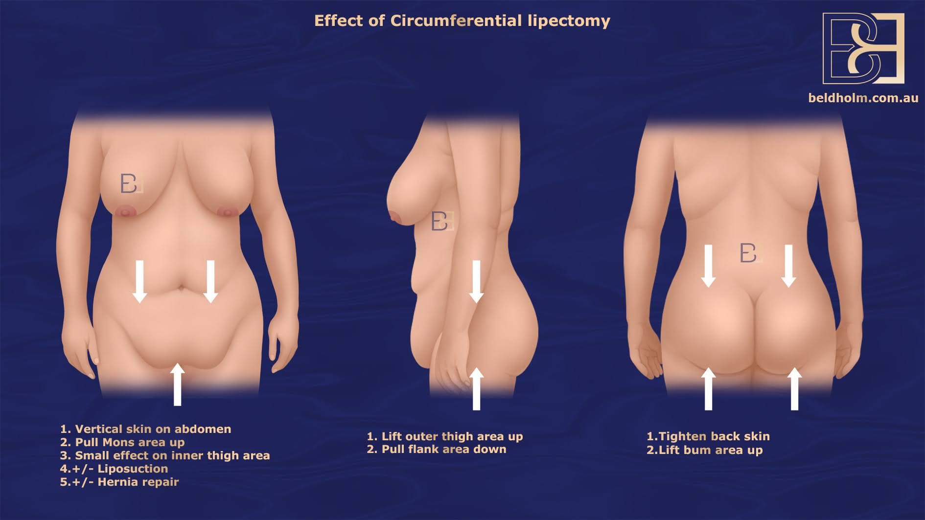 Effects of Circumferential Lipectomy