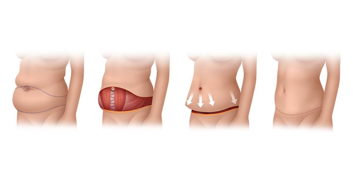 Excess skin extending to the flanks