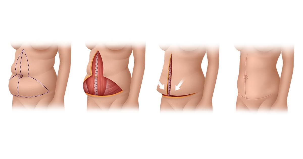 Excess skin in both vertical and horizontal directions