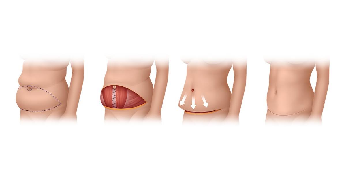 Excess skin mainly on the lower abdomen