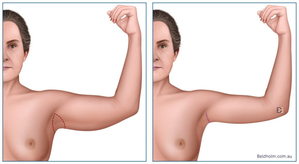 Brachioplasty (Arm Lift) Post Weight Loss 5 Limited Brachioplasty (Sometimes Referred to as a Mini Arm Lift)