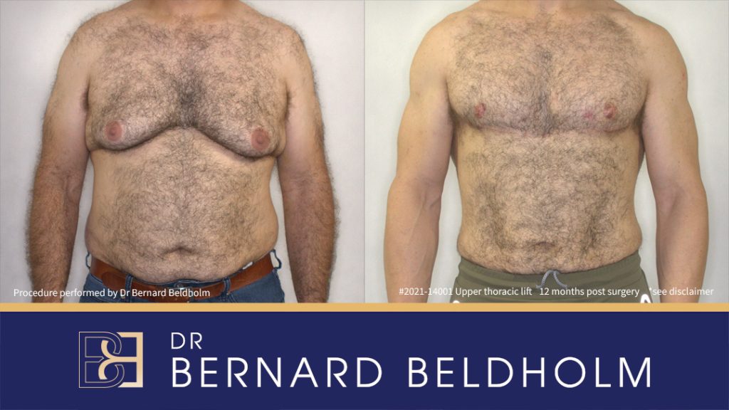 Male Chest Surgery Post-Weight Loss: Understanding Upper Body Lift (Torsoplasty) 1 Patient 2021-14001 Grade BB 4c Gynaecomastia Post Significant Weight Loss and Prior Gynaecoamstia Before & After - Front