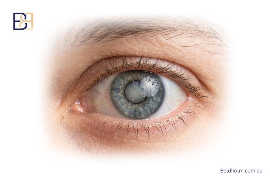 Vitamin A and age-related eye disease
