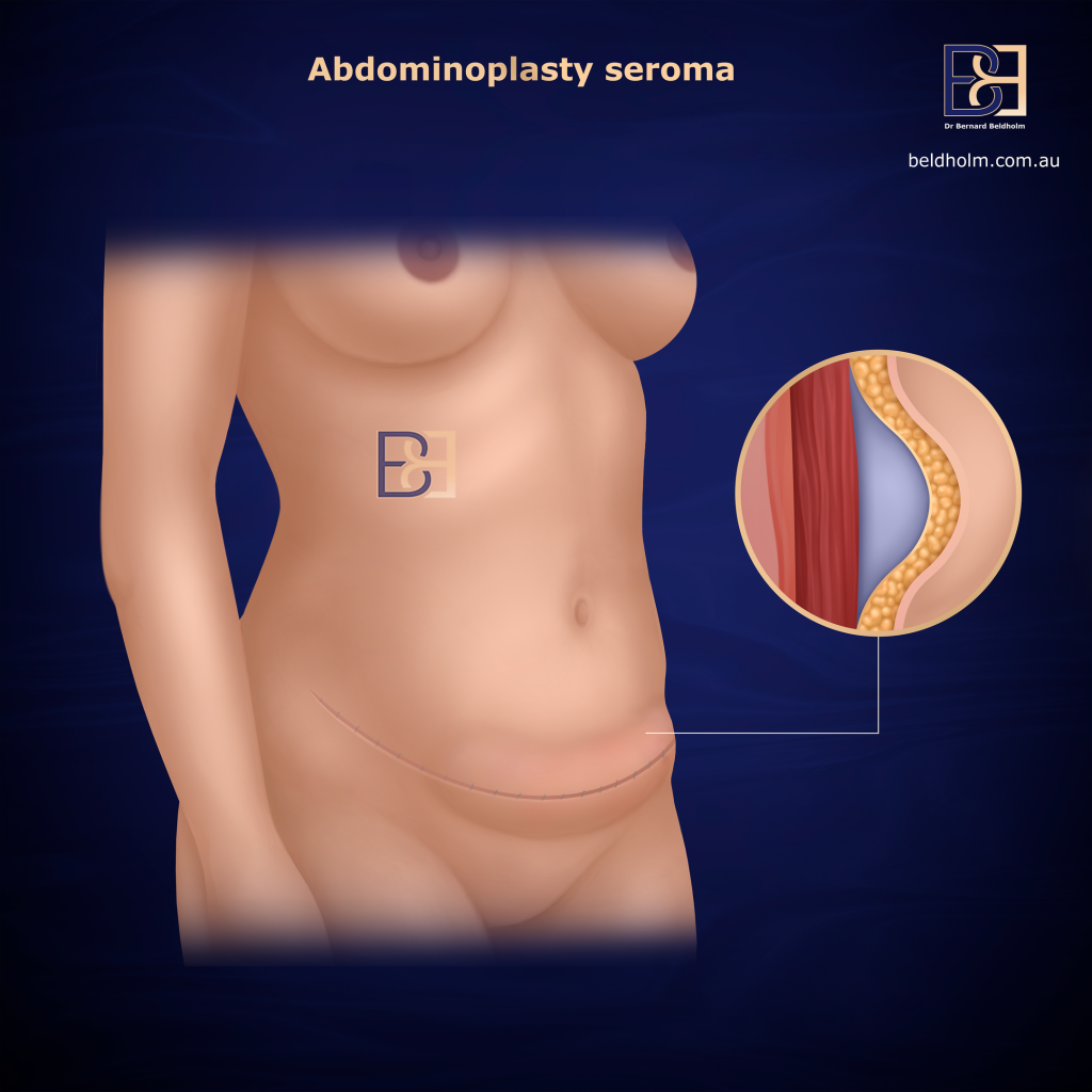 A Note on Seroma
