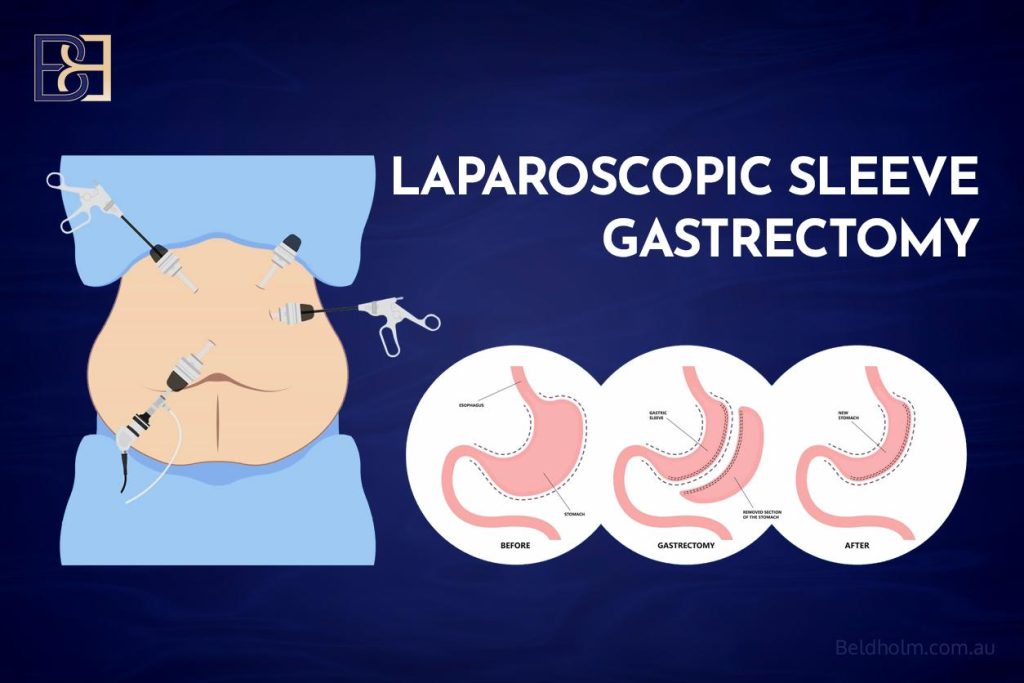 After sleeve gastrectomy