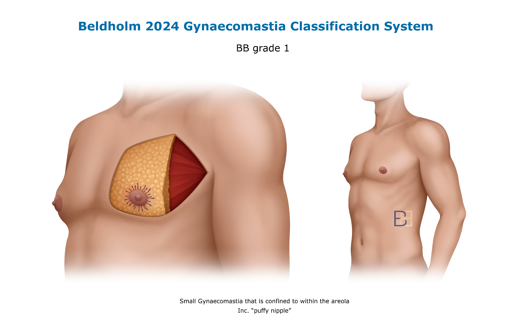 Bledholm 2024 Gynaecomastia Classification BB Grade 1