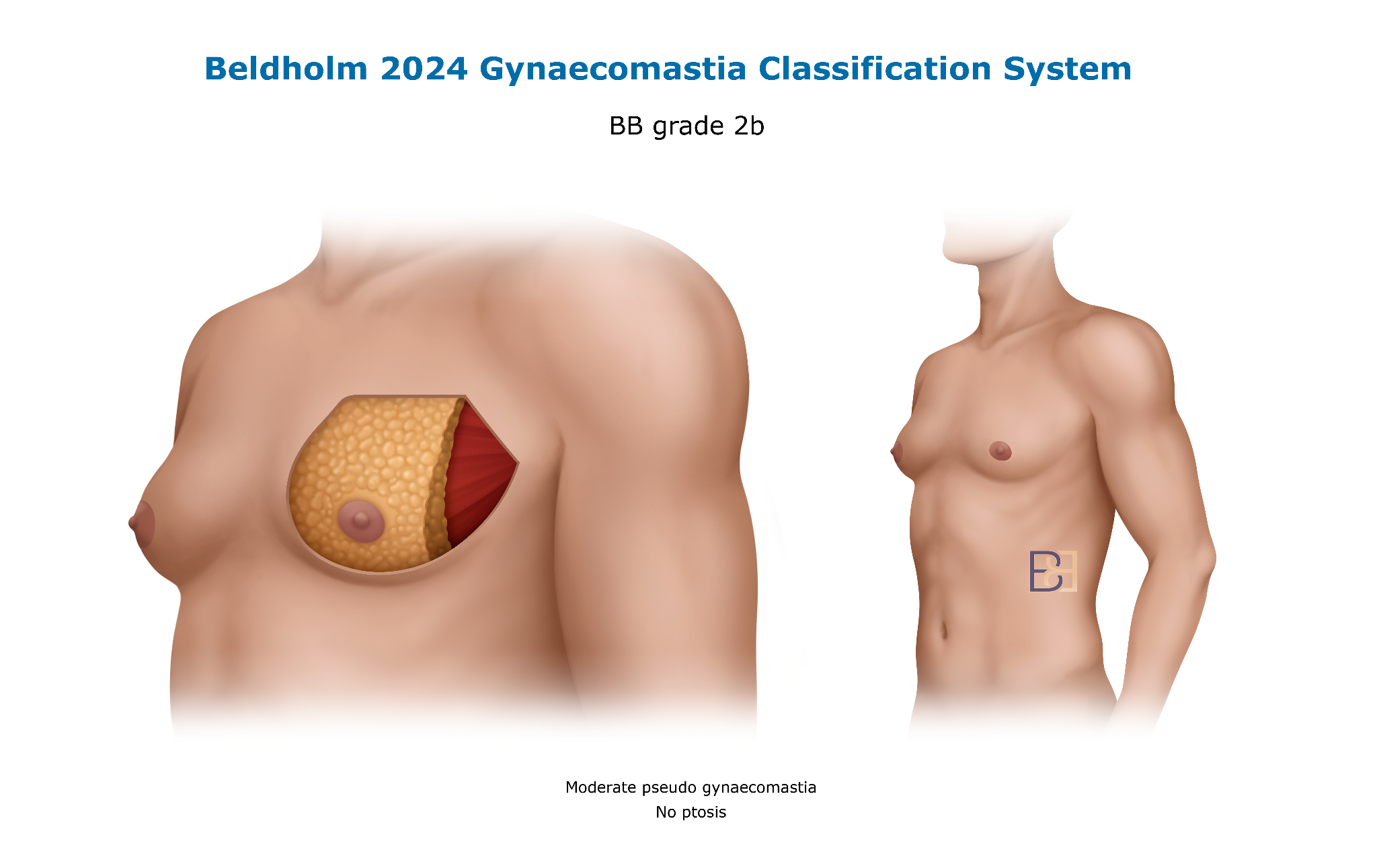 Bledholm 2024 Gynaecomastia Classification BB Grade 2b