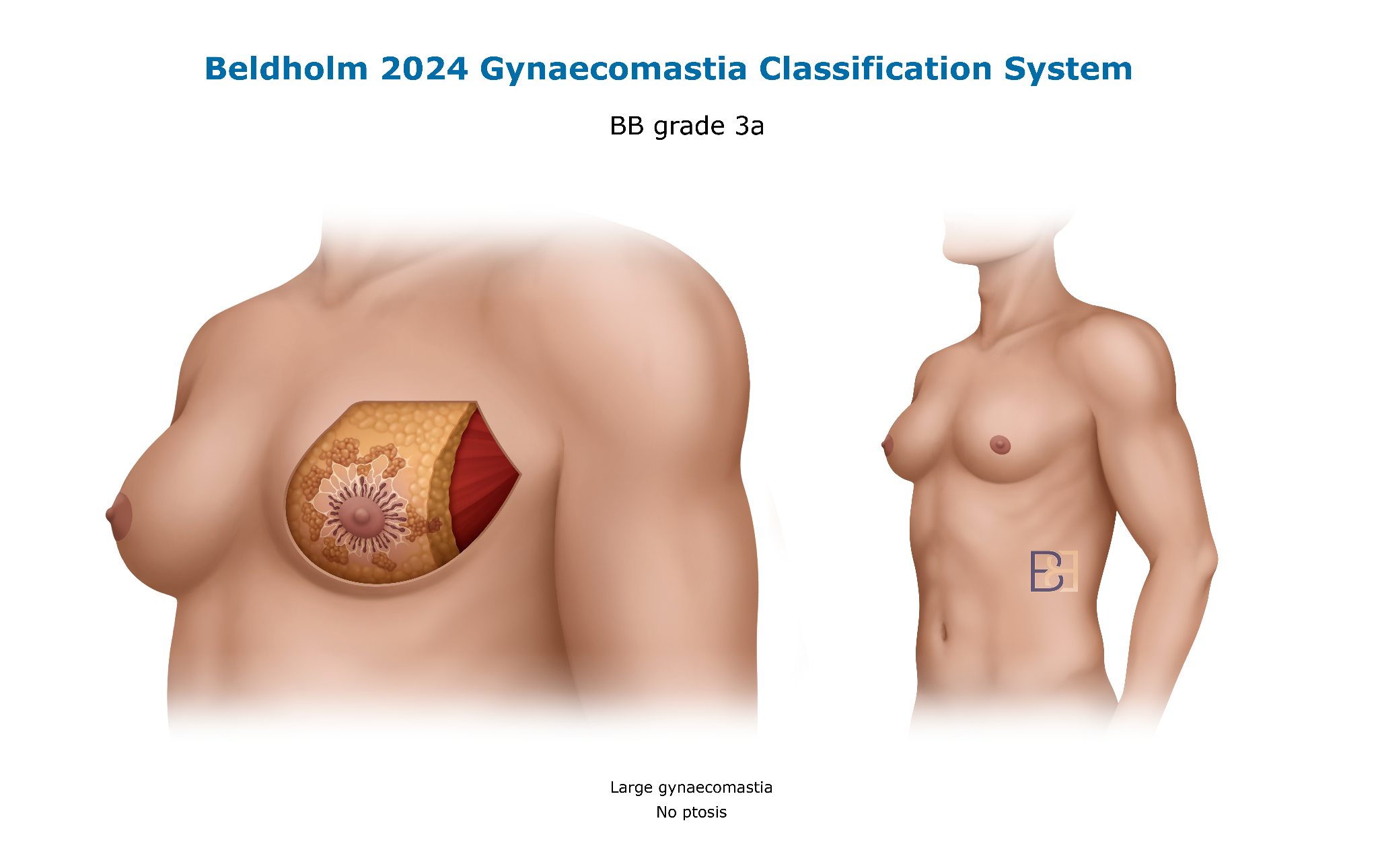 Bledholm 2024 Gynaecomastia Classification BB Grade 3a