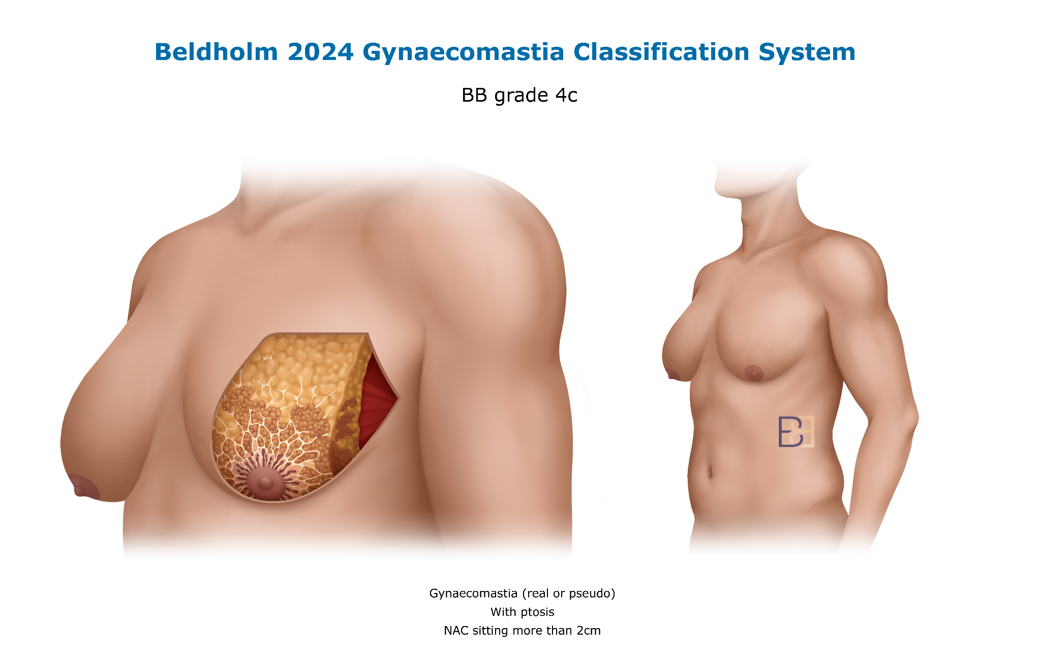 Bledholm 2024 Gynaecomastia Classification BB Grade 4c
