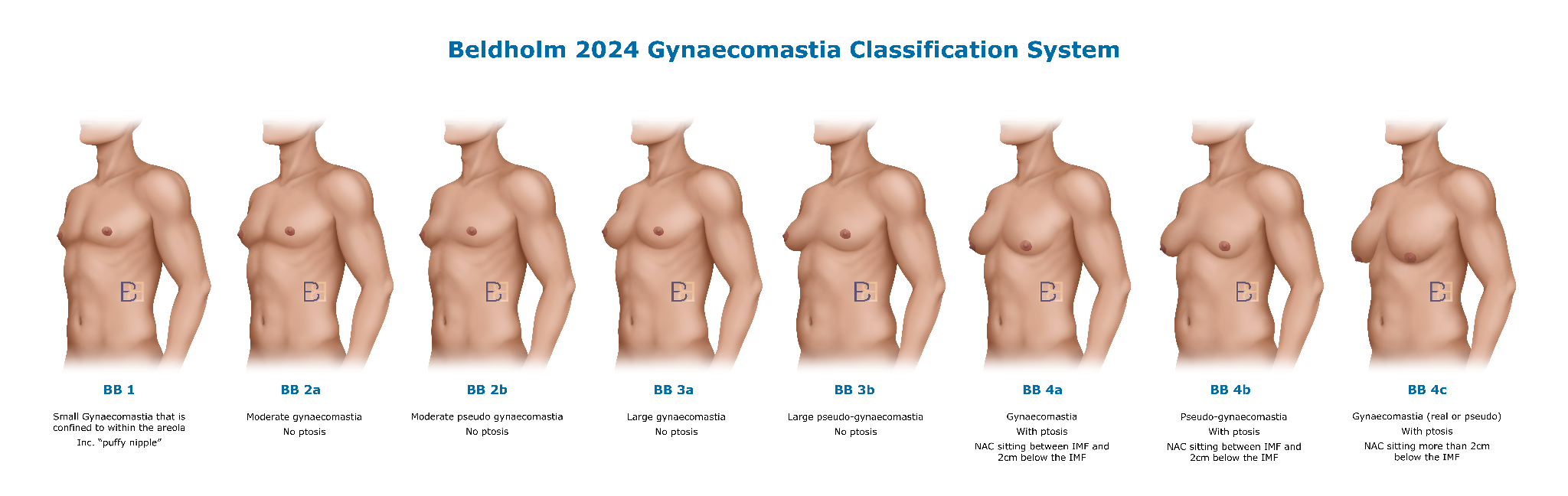 Bledholm 2024 Gynaecomastia Classification