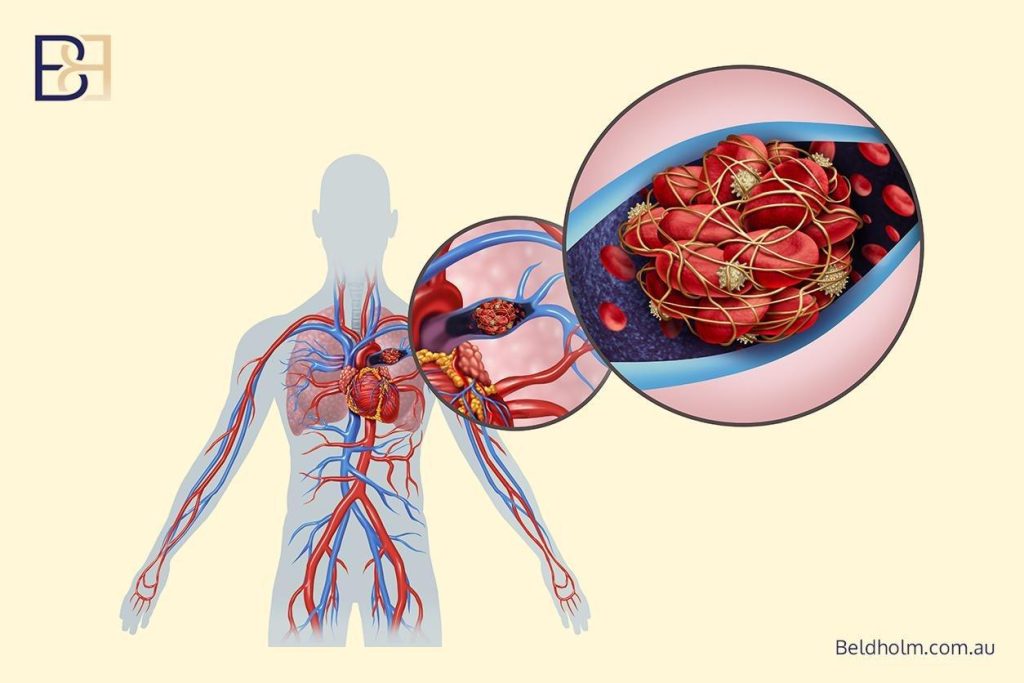 Complications After Upper Torsoplasty (upper body lift) Surgery in Men: Anterior Torsoplasty, Circumferential Torsoplasty, and VASER-Assisted Upper Body Lift Surgery 8 Blood Clot Prevention