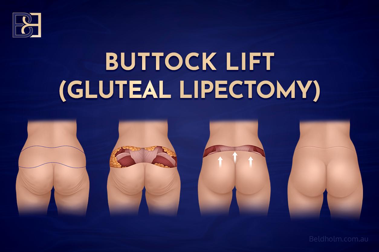 What is a Gluteal Lipectomy (buttock lift)
