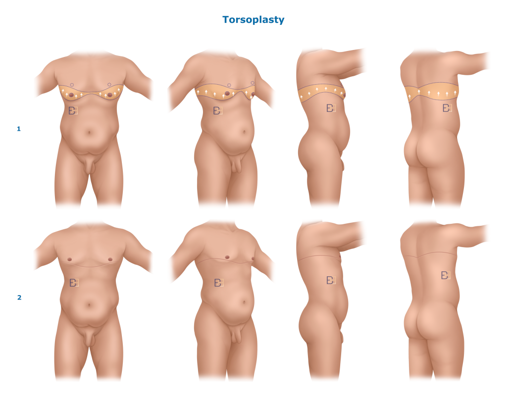 Circumferential upper body lift in men (upper torsoplasy or upper circumferential lipectomy)
