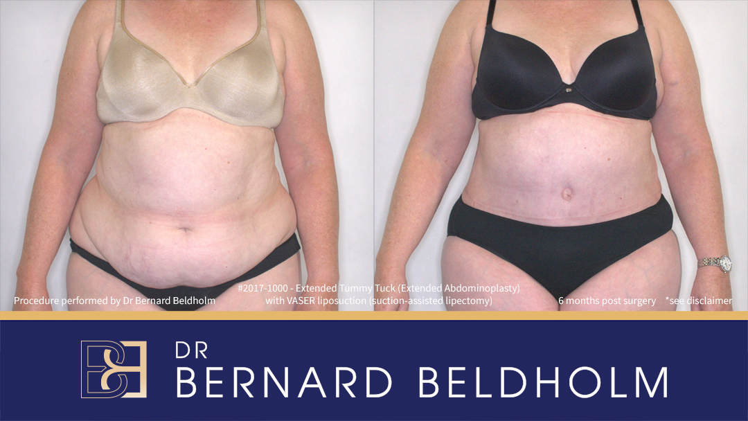 Patient 2017-1000 - Extended Abdominoplasty with VASER Liposuction (Suction-assisted Lipectomy) - Front