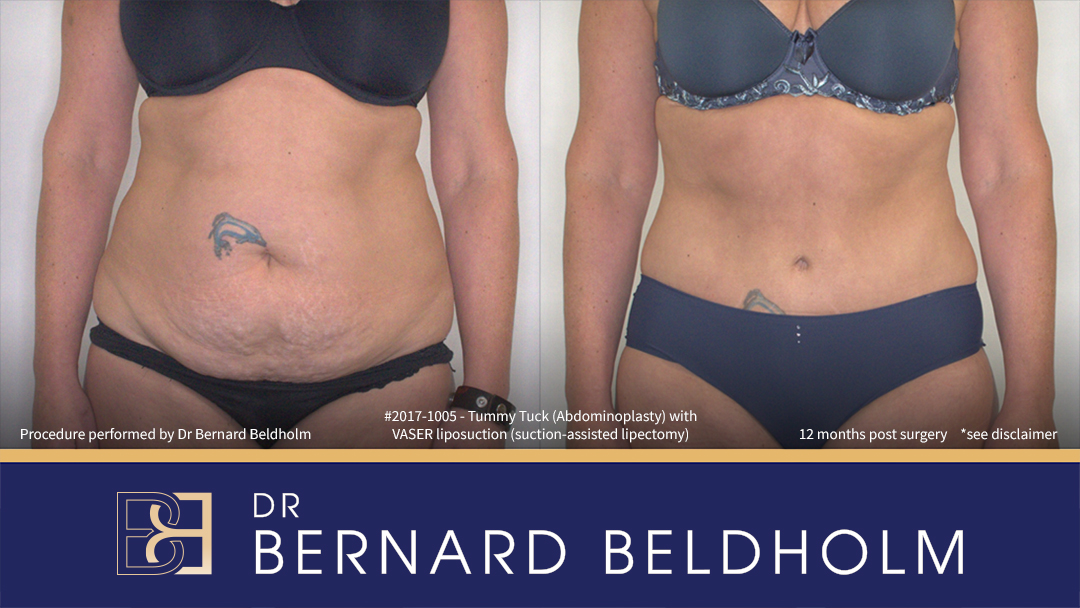 Patient 2017-1005 - Tummy Tuck (Abdominoplasty) with VASER Liposuction (Suction-assisted Lipectomy) - Front