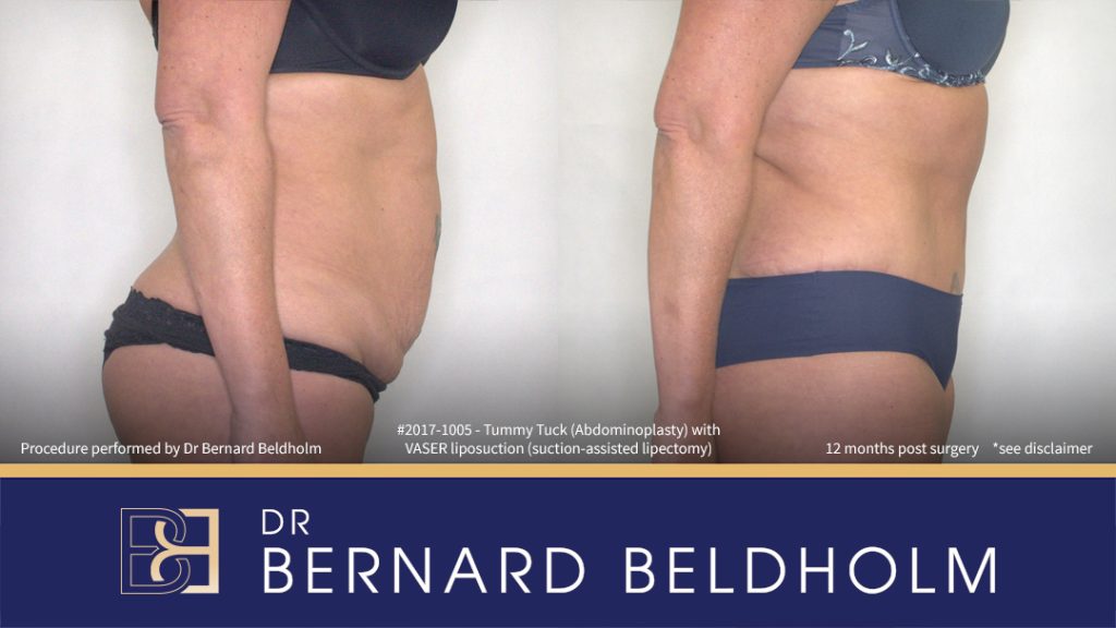 Abdominoplasty Post Pregnancy Patient 2017-1005 2 Patient 2017-1005 - Tummy Tuck (Abdominoplasty) with VASER Liposuction (Suction-assisted Lipectomy) - Left Side