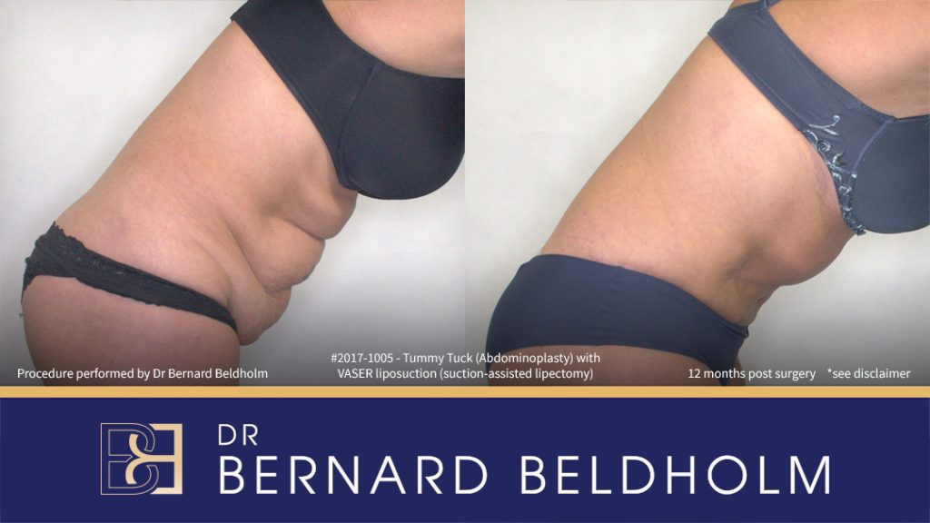 Abdominoplasty Post Pregnancy Patient 2017-1005 3 Patient 2017-1005 - Tummy Tuck (Abdominoplasty) with VASER Liposuction (Suction-assisted Lipectomy) - Left Side Bend