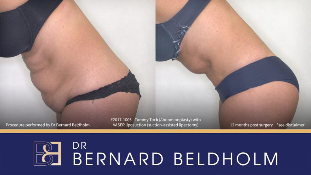Abdominoplasty Post Pregnancy Patient 2017-1005 4 Patient 2017-1005 - Tummy Tuck (Abdominoplasty) with VASER Liposuction (Suction-assisted Lipectomy) - Right Side Bend