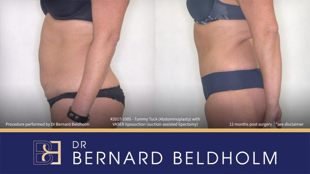 Abdominoplasty Post Pregnancy Patient 2017-1005 5 Patient 2017-1005 - Tummy Tuck (Abdominoplasty) with VASER Liposuction (Suction-assisted Lipectomy) - Right Side