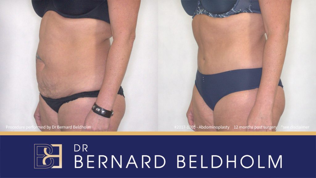 Abdominoplasty Post Pregnancy Patient 2017-1005 6 Patient 2017-1005 - Tummy Tuck (Abdominoplasty) with VASER Liposuction (Suction-assisted Lipectomy) - Right