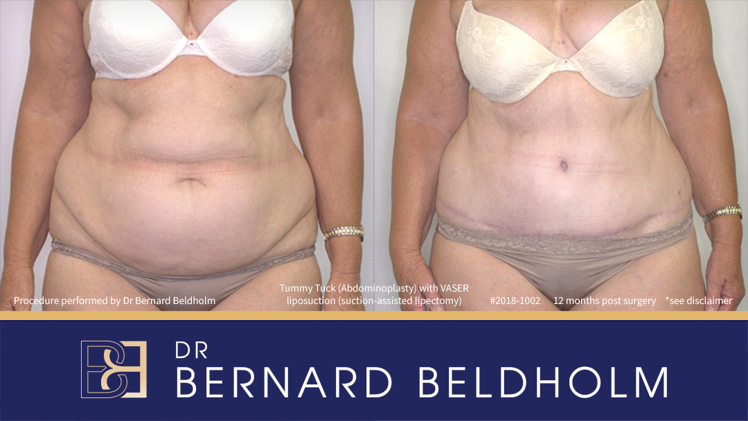 Patient 2018-1002 - Extended Abdominoplasty with VASER Liposuction (Suction-assisted Lipectomy) - Front