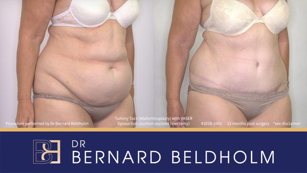 Patient 2018-1002 - Extended Abdominoplasty with VASER Liposuction (Suction-assisted Lipectomy) - Left