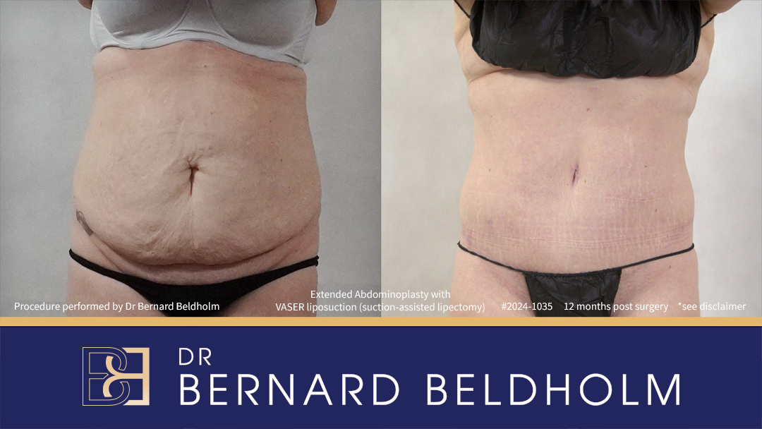 Patient 2024-1035 - Extended Abdominoplasty with VASER Liposuction (Suction-assisted Lipectomy)