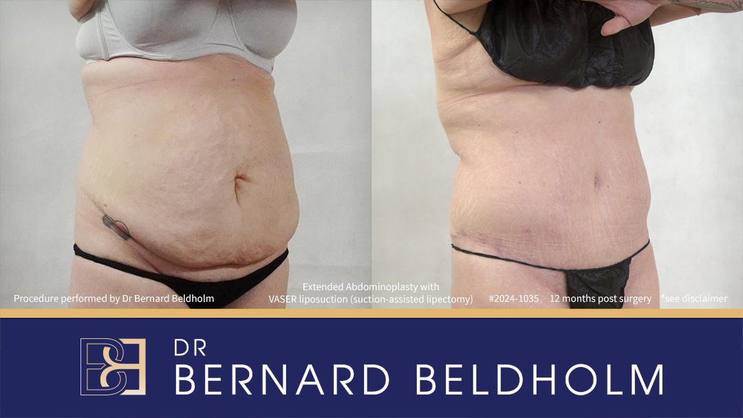 Patient 2024-1035 - Extended Abdominoplasty with VASER Liposuction (Suction-assisted Lipectomy) - Left