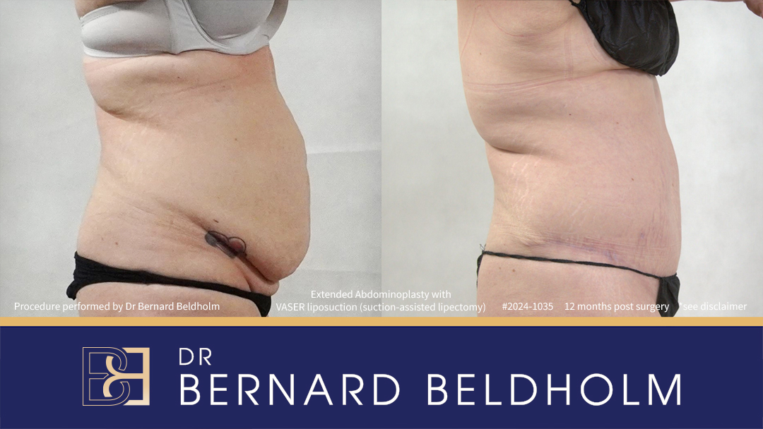 Patient 2024-1035 - Extended Abdominoplasty with VASER Liposuction (Suction-assisted Lipectomy) - Left Side