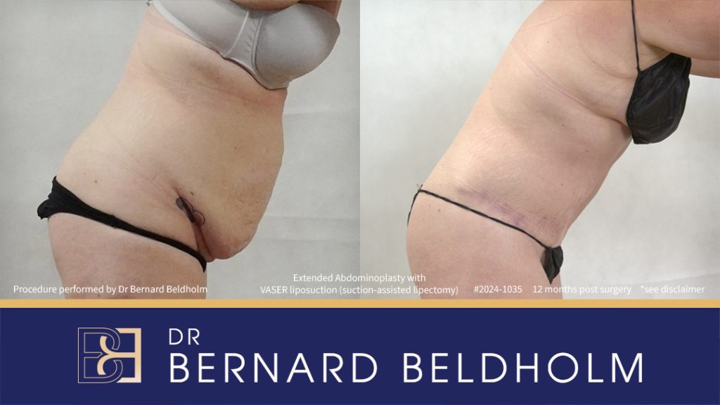 Patient 2024-1035 - Extended Abdominoplasty with VASER Liposuction (Suction-assisted Lipectomy) - Left Side Bend