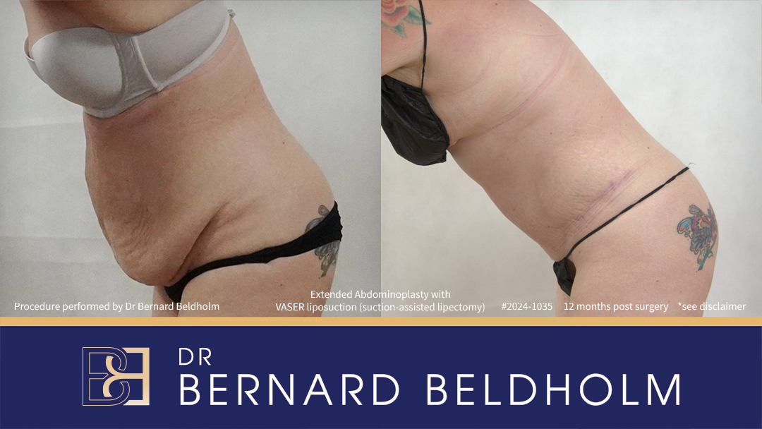 Patient 2024-1035 - Extended Abdominoplasty with VASER Liposuction (Suction-assisted Lipectomy) - Right Side Bend