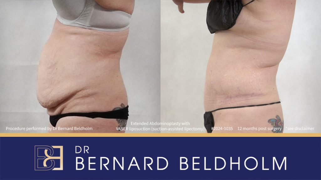 Patient 2024-1035 - Extended Abdominoplasty with VASER Liposuction (Suction-assisted Lipectomy) - Right Side
