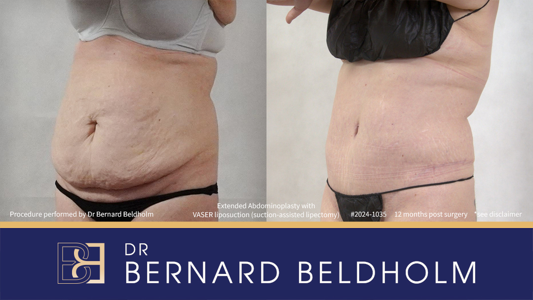 Patient 2024-1035 - Extended Abdominoplasty with VASER Liposuction (Suction-assisted Lipectomy) - Right