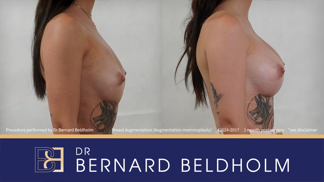 Round Breast Implants (Augmentation Mammoplasty) Patient 2024-2017 3 Breast Augmentation (Augmentation Mammoplasty) (Patient 2024-2017) - Left Side