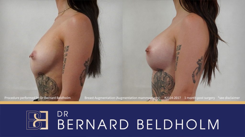 Round Breast Implants (Augmentation Mammoplasty) Patient 2024-2017 4 Breast Augmentation (Augmentation Mammoplasty) (Patient 2024-2017) - Right Side