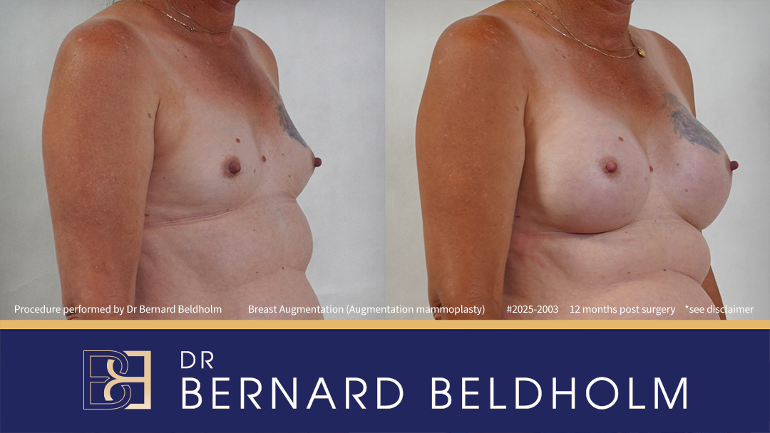 Patient 2025-2003 - Breast Augmentation (Augmentation Mammoplasty)