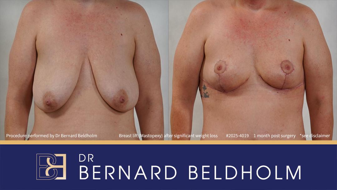 Patient 2025-4019 - Breast Lift (Mastopexy) After Significant Weight Loss of 40 kg