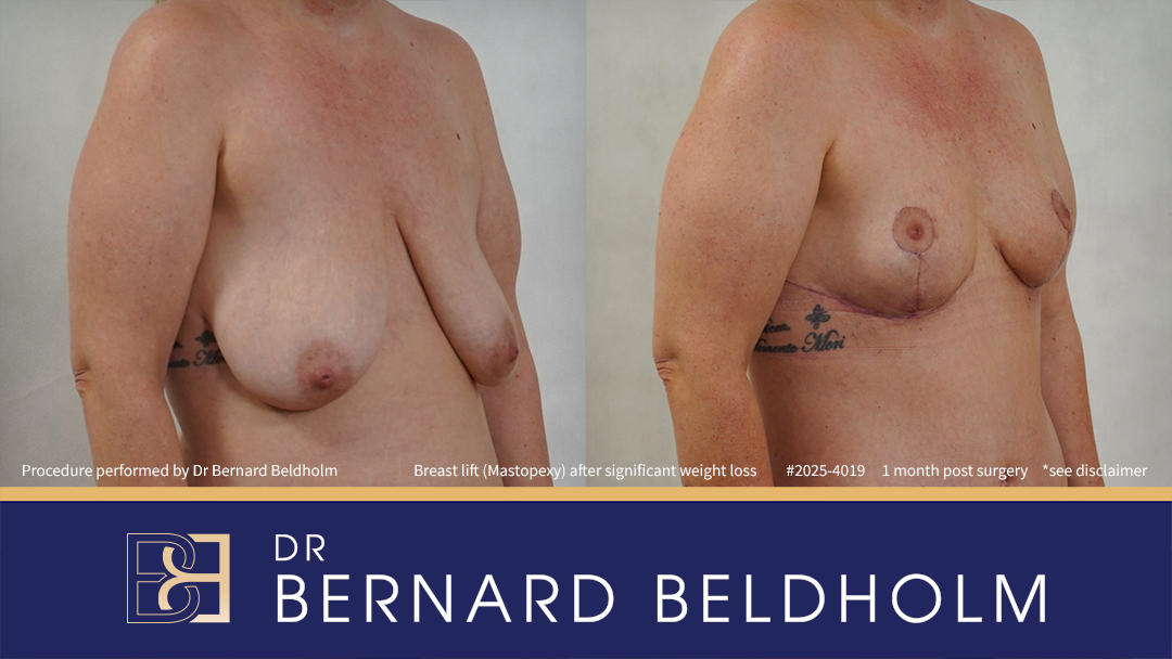 Breast Lift (Mastopexy) After Significant Weight Loss of 40 kg (Patient 2025-4019) - Left