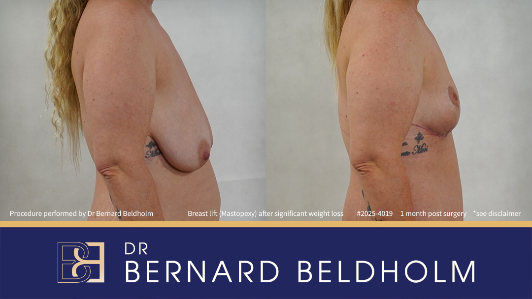 Breast Lift (Mastopexy) After Significant Weight Loss of 40 kg (Patient 2025-4019) - Left Side