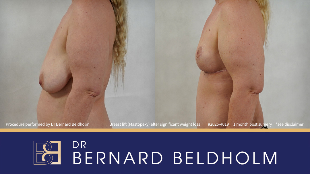 Breast Lift (Mastopexy) After Significant Weight Loss of 40 kg (Patient 2025-4019) - Right Side